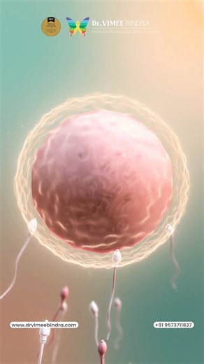 Ovulation should not cause severe pain. In Endometriosis, lesions contain nerve fibers and sit within chronically inflamed tissue. During ovulation, the rise in inflammatory mediators like prostaglandins irritates these nerves — leading to sharp, one-sided, stabbing pain that is often mislabeled as “normal ovulation pain.” Persistent or worsening ovulation pain is a clinical red flag, not a routine cycle symptom. It deserves proper evaluation, early diagnosis, and disease-directed management, no