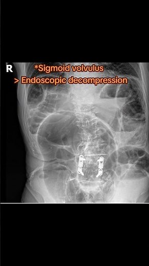 Endoscopic decompression due to Sigmoid volvulus