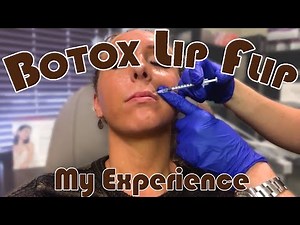Getting a Botox Lip Flip | My Honest Experience | Before & After | Botox Injection Footage