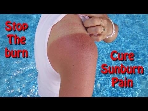 Home Remedies For Sunburn Relief