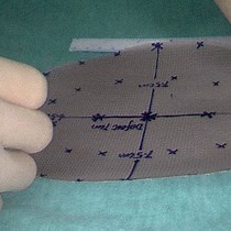 Video: Application of a New Mesh Fixation Method in Laparoscopic Incisional Hernia Repair