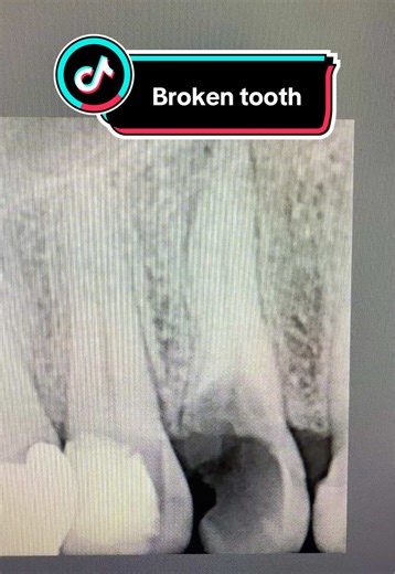 Understanding Broken Tooth Care