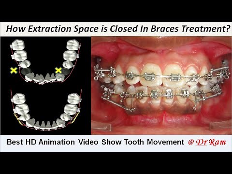 How Extracted Premolars Space is Closed by Braces?? Best Animation to Know Sliding Mechanics @Dr Ram