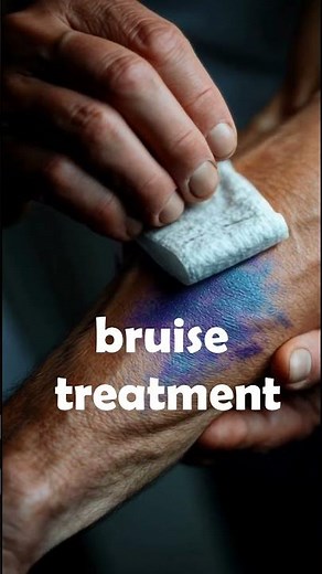 how to get rid of bruises fast ? | bruise treatment at home | heal bruises quickly & naturally