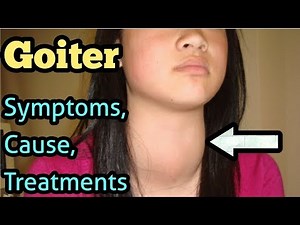 Goiter: Symptoms, Causes, Treatment