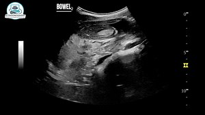 Adult Colonic Intussusception Identified on Ultrasound Clinical Indication Abdominal pain / suspected bowel pathology. ⸻ Technique High-resolution real-time transabdominal ultrasonography performed using curvilinear probe. Focused bowel evaluation done in transverse and longitudinal planes. ⸻ Findings • In the right abdominal region, involving the ascending colon extending into the transverse colon, a bowel-within-bowel configuration is noted. • On transverse imaging, the involved bowel segment 