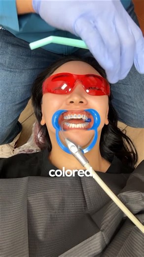 Jasmine Belle Pak on Instagram: "What REALLY happens at your first Invisalign appointment?! The ATTACHMENTS! Spiraling aside, my journey has been sooo smooth and I’m loving my results thus far!!! (Currently about 3 months in) Huge shout out to the one and only Dr. Youssef aka the Smile Doctor @drfitsmiles 🦷 for the best treatment ever! If you’re looking to get @invisalign, highlyyyy recommend seeing Dr. Youssef 💎 📍 FitSmiles Orthodontics Address: 14051 Newport Ave F, Tustin, CA 92780"