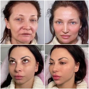 3.8M views · 838 reactions | Plastic surgery transformations! | MetDaan | Facebook
