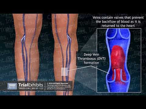 Surgical Placement of Inferior Vena Cava Filter to Prevent DVT