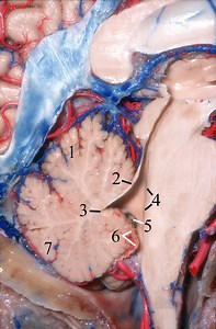 Fourth Ventricle Approaches | Cohen Collection | Volumes | The Neurosurgical Atlas