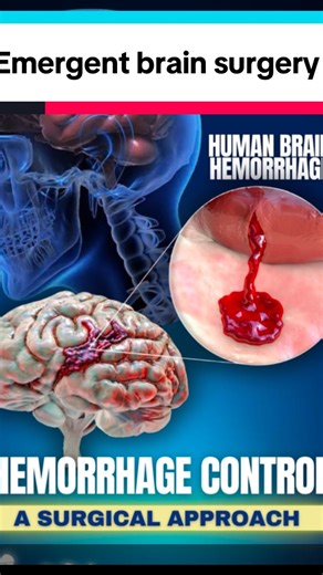 Zayed Almadidy, MD | This is a life saving surgery to decompress the brain. #craniectomy #craniotomy #brainsurgery #neurosurgery #emergency #medical #doctor... | Instagram