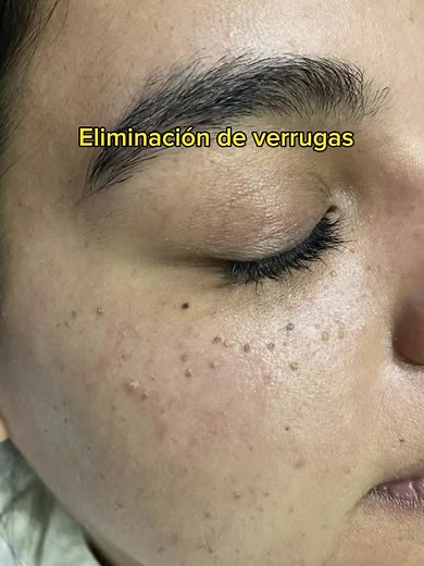 Tratamiento de Plasma Pen para Eliminación de Verrugas y Lunares