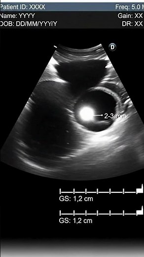 5 Weeks Pregnancy Ultrasound | Baby’s First Look Inside the Womb 👶
