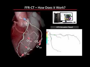 Fractional Flow Reserve Coronary CTA