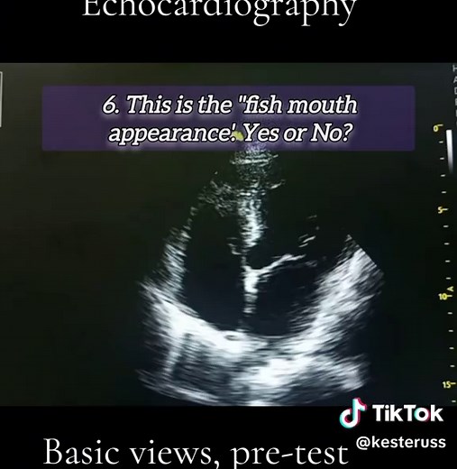 #cardiacphysiology #echocardiography #echotech #mattersoftheheart #fyp