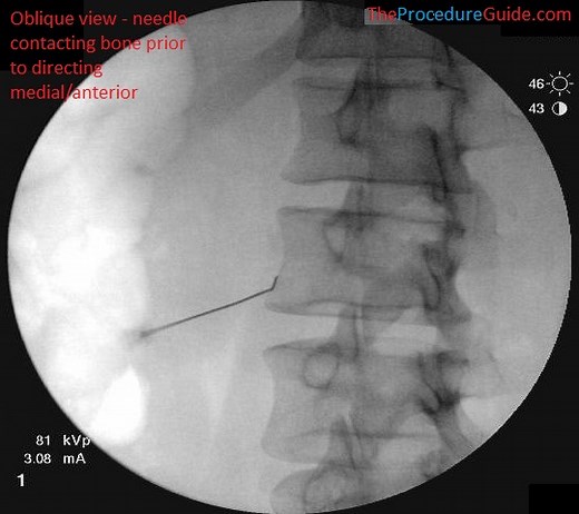 Lumbar Sympathetic Block - Technique and Overview - The Procedure Guide