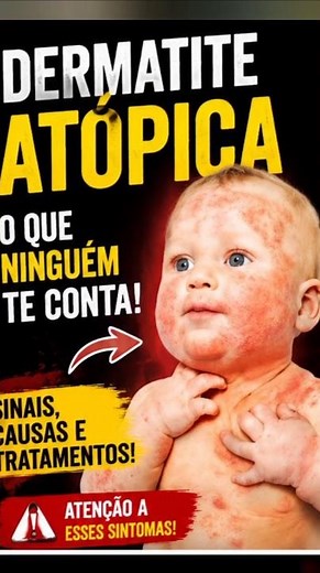 Atopic Dermatitis: Why Does Your Skin Itch So Much? 😱