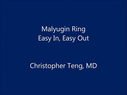 How to use Malyugin Ring. Easy In, Easy Out #Ophthalmic_Surgery #Phaco | Piece of ophthalmology