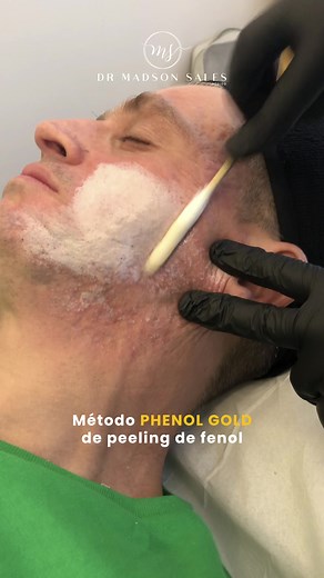 Soluções de Cicatrizes de Acne e Rejuvenescimento