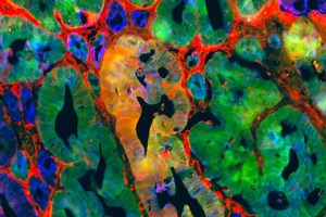 Moving the Needle on Appendiceal Cancer