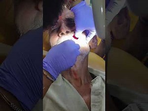 Painless grossly decayed tooth extraction