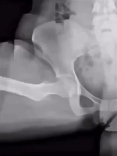 What you’re watching is Dynamic Digital Radiography (DDR) — a next-gen, low-dose X-ray technology that doesn’t just take pictures… it records movement in real time. Unlike normal X-rays that freeze the body in one position, DDR shows joints, lungs, and bones while they MOVE. 👀✨ 🦵 Hips & knees – see abnormal joint motion 💪 Shoulders & arms – detect impingement, instability & tendon problems 🫁 Chest & lungs – watch breathing mechanics and lung expansion 🦴 Spine & joints – evaluate functional 
