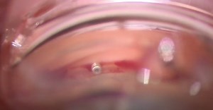 iStent Infinite and iDose Implantation - Eyetube