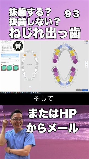抜歯しない矯正 出っ歯、前歯ねじれ 口ゴボ 八重歯 ワイヤー矯正安い費用50万円〜鈴木歯科医院 埼玉県さいたま市大宮 矯正歯科医院 マウスピース矯正 茨城県東京千葉からも受付