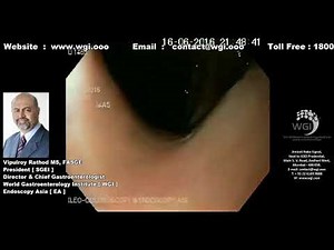 MANAGEMENT OF RECTAL STRICTURE WITH ENDOSCOPIC BALLOON DILATATION