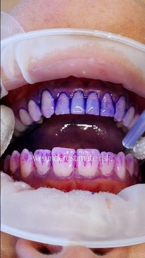 Pink vs. Blue Disclosing agent.