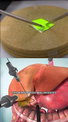 How Laparoscopic Surgery Works