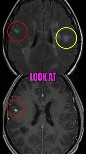Two New Brain Lesions Discovered on MRI