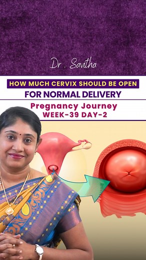 171K views · 1.7K reactions | How much cervix dilation is needed for...