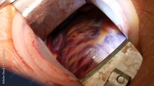 Close up of cardiovascular surgery doctor in surgery center for interventions with instruments in surgeon operation electrosurgery with thoracotomy microsurgery doing heart surgery