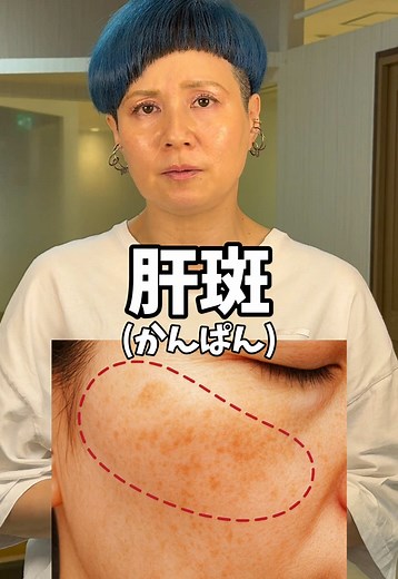 肝斑のケア方法とスキンケアの秘訣