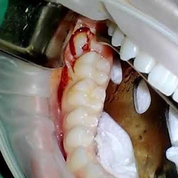 Dental Extraction Video: Mesioangular Impaction #32 with Sectioning