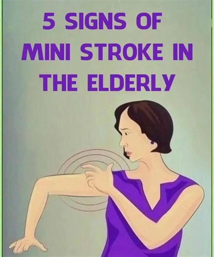 5 signs of mini stroke in the elderly Check 1st comment 👇 | Good Times