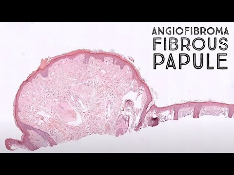Angiofibroma (fibrous papule): clinical mimic of basal cell carcinoma (pathology dermatology)