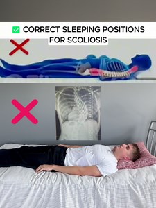 Scoliosis Sleeping Positions That Reduce Pain and Support Your Curve