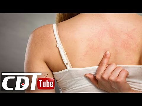 Urticaire : 9 traitements naturels pour la soigner vite et bien | CDT NEWS