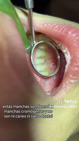 Limpieza Dental: Combate Manchas Cromógenas Efectivamente