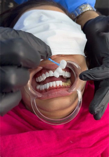 Hollywood Smile with Zirconium Crowns at Numan Dental