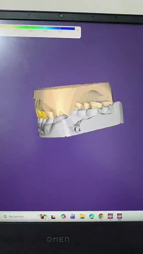 Full Zircone Dental Design with Exocad Techniques