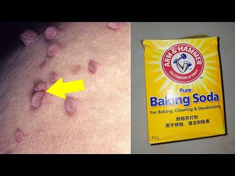 How to removing skin tags with baking soda and castor oil and toothpaste at home