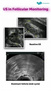 Effective ovulation induction requires precise serial ultrasound exams! Baseline: Confirming ovaries are quiescent (follicles