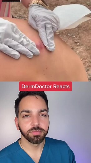 Infected Epidermal Inclusion Cyst Treatment | DermDoctor Reacts