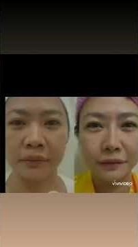 Hiko nose threadlift...