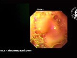 Endoscopy for Large Sliding Hiatal Hernia with Intrathoracic Stomach • Video • MEDtube.net