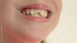 Opening his mouth. The child's front teeth are knocked out