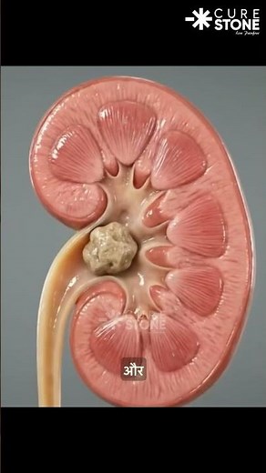 Passing a Kidney Stone NATURALLY: Inside the Ureter (3D Animation)